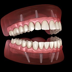 Illustration of implant dentures
