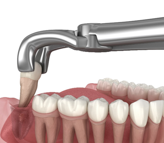 Illustration of a tooth being extracted