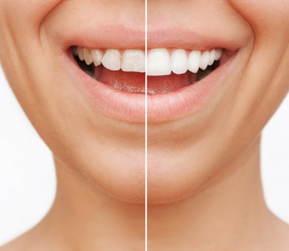 Before and after veneers treatment